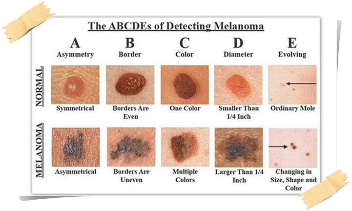 autoesame-melanoma